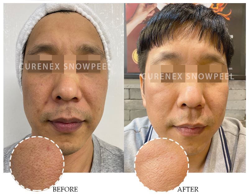 Curenex - SNOWPEEL C-Tox Peel - XQ