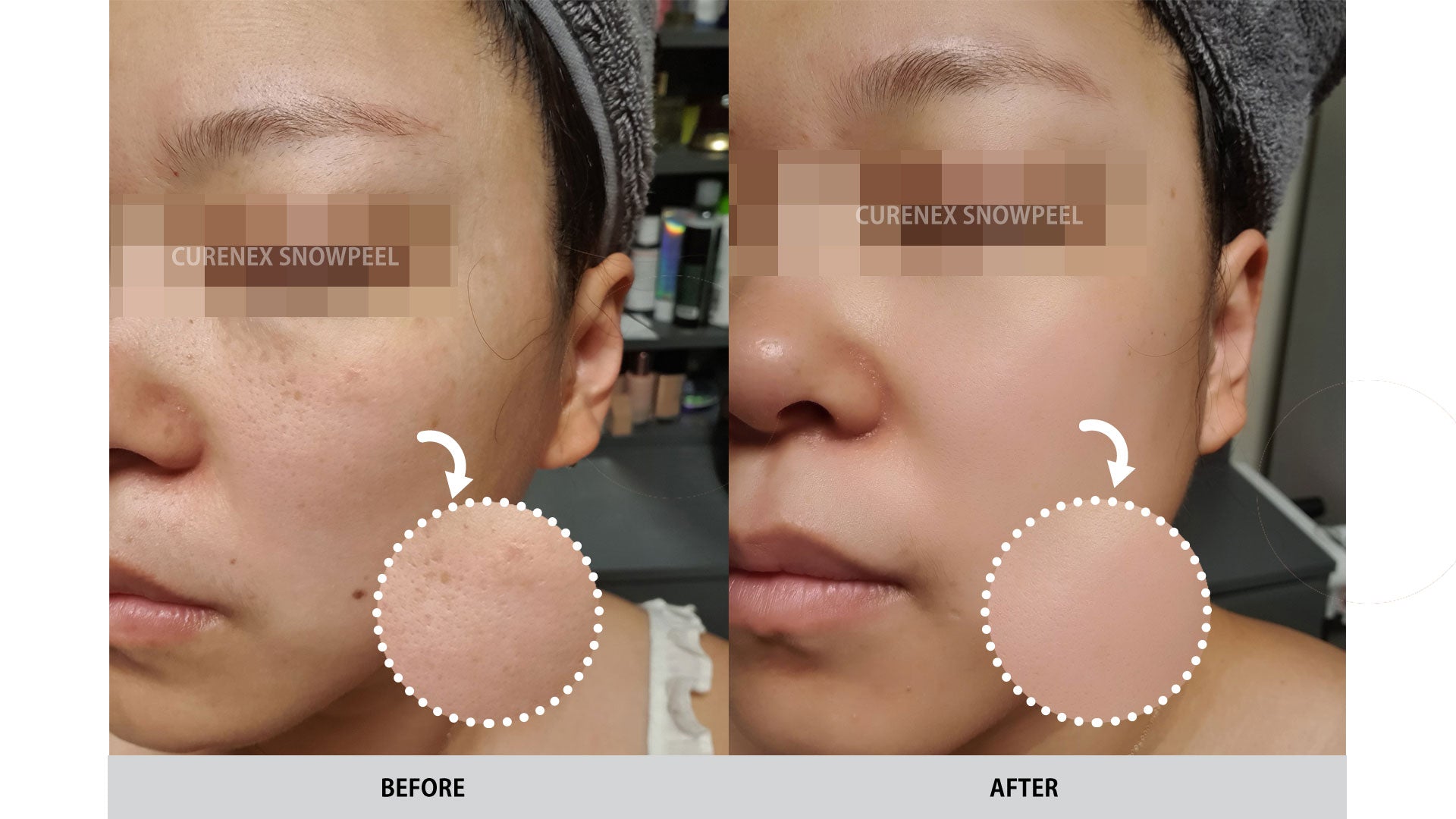 Curenex - SNOWPEEL C-Tox Peel - XQ