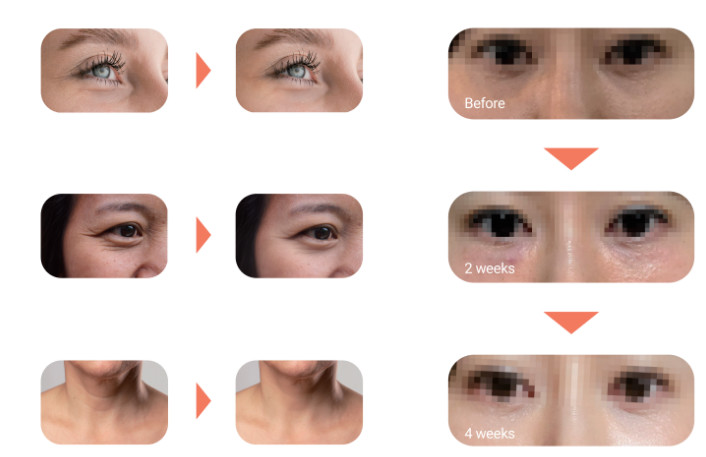 Eyebella - PN Skin Booster - XQ