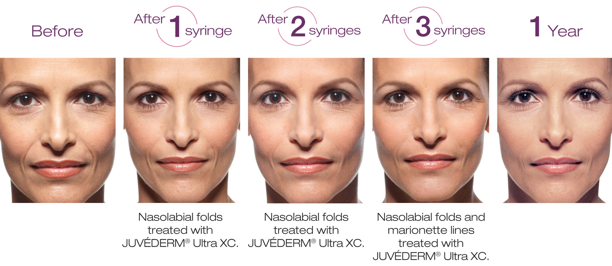Juvéderm Ultra Plus XC (2 x 1ml) - XQ
