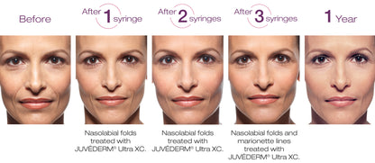 Juvéderm Ultra Plus XC (2 x 1ml) - XQ