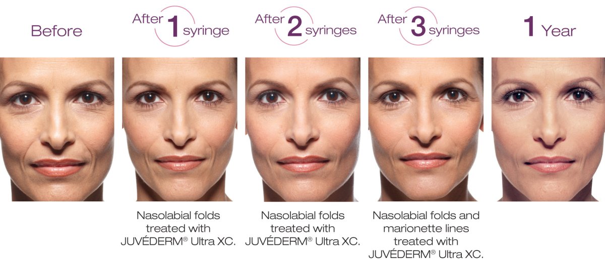 Juvéderm Ultra Plus XC (2 x 1ml) - XQ