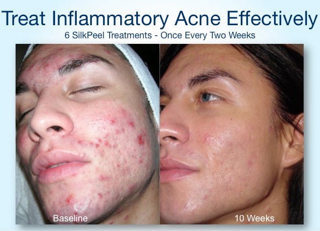 OR`JADE Silky Peel (AHA 30%) - XQ