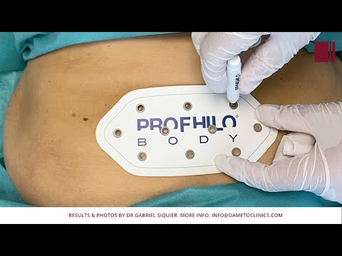 Profhilo H+L 2 ml 