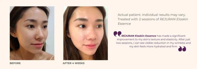 Rejuran Elaskin Essence - XQ